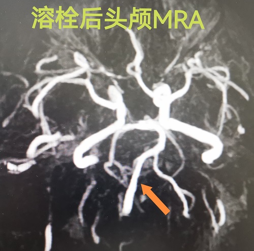 溶栓后闭塞的右侧椎动脉被完全开通.jpg